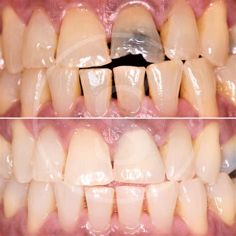 Veneers Wembley | Tooth Covers | Cosmetic Dental Practice Harrow