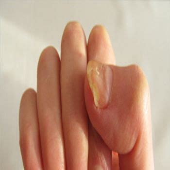 Causes, Symptoms, Treatments | Common Nail Problems | Nail problems ...