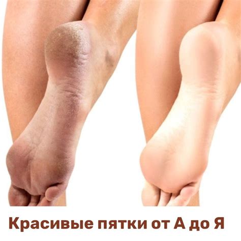 Красивые пятки от А до Я в 2024 г | Сухие пятки, Мягкие пятки, Сухая кожа
