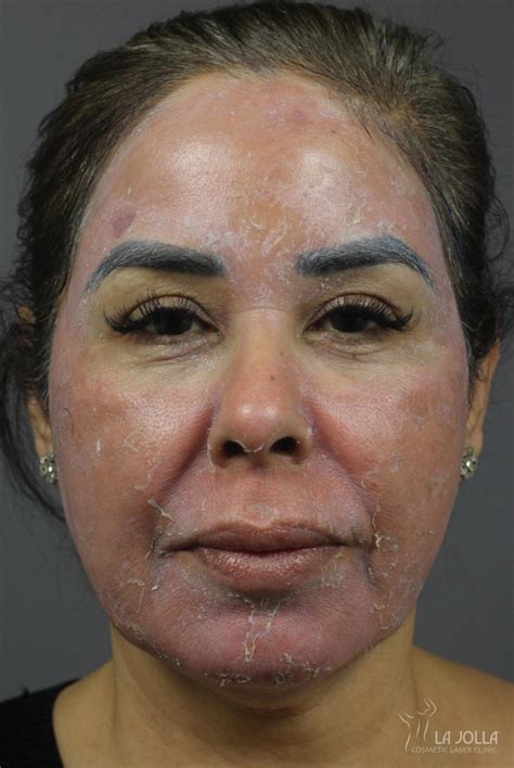 Chemical Peel Before & After Gallery: Patient 3