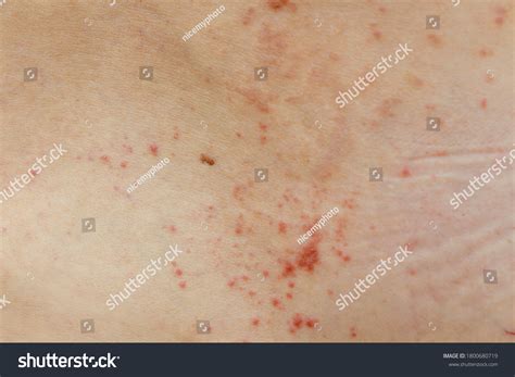 skin disease prickly heat rash miliaria shutterstock