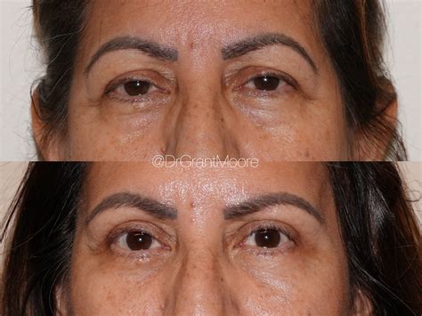 Ophthalmic Plastic Surgery Gallery | Barnet Dulaney Perkins AZ