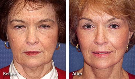 non surgical face lift before and after photos - grengs