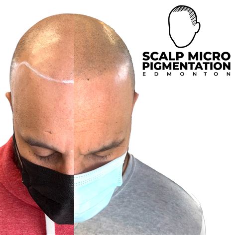 Scalp micro pigmentation will change the way men cut bald 5