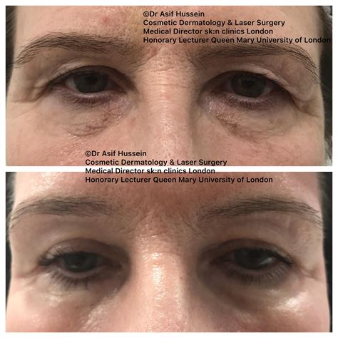 Laser Eyelid Lift
