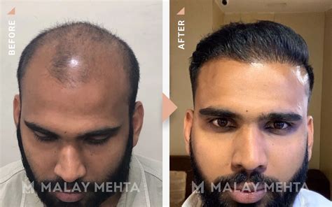 Top Hairline Reconstruction Mumbai - Malay Mehta Aesthetic Clinic