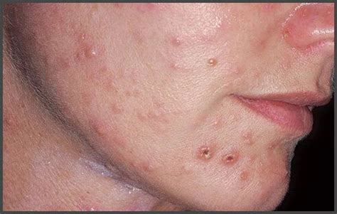 Shingles pictures face | Shingles Expert