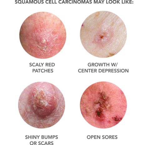 stage 4 squamous cell carcinoma life expectancy without treatment