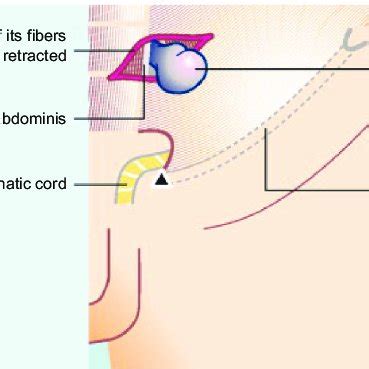 spiegel's hernia: male anatomic view. | Download Scientific Diagram