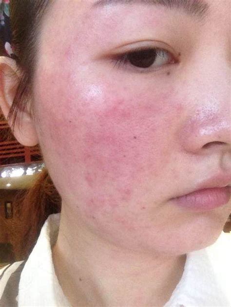 脸皮肤过敏图片大全,身上过敏图片大全,宝宝花粉过敏症状图片_大山谷图库