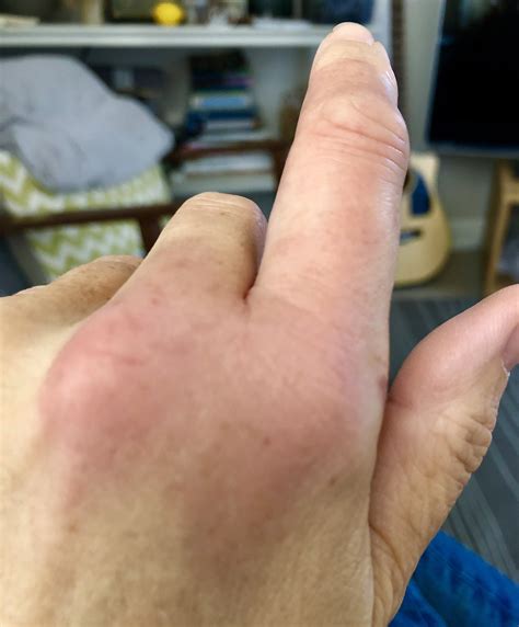 how to treat wasp bite 8