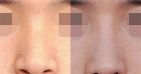 Shimmian Rhinoplasty Clinic (official blog in Korea): Correction of ...
