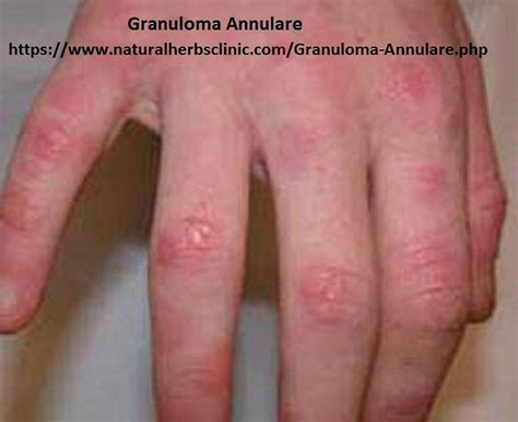 granuloma annulare pixabay pixabay