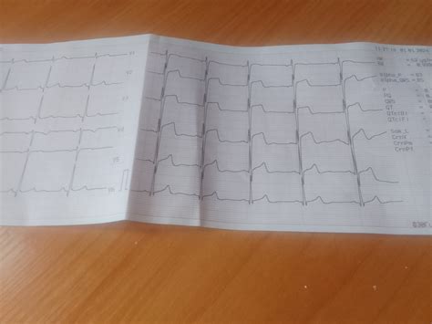 Вопросы врачам: ЭКГ | MedAboutMe