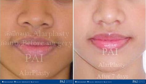 Alar reduction - PAI Clinic