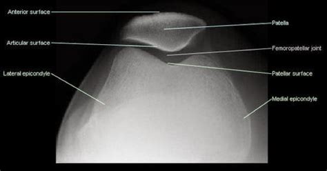 Diagnostic Medical Imaging : Patella skyline view x ray anatomy