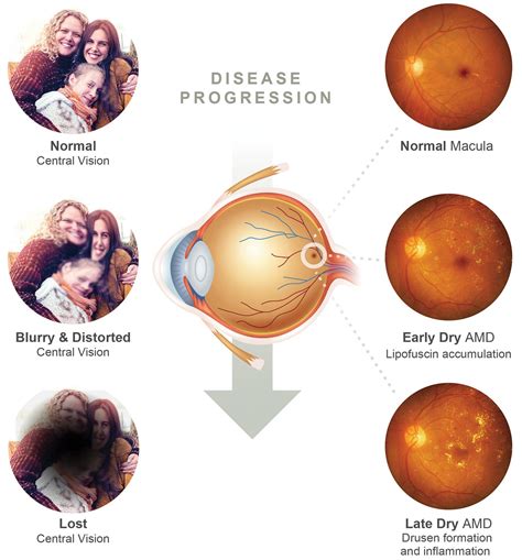 Symptoms Of Retinal Diseases - vrogue.co