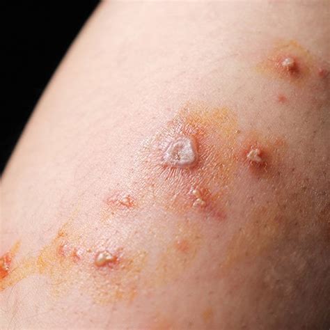 impetigo  symptoms treatment impetigo