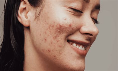 reduce pimple redness  home software