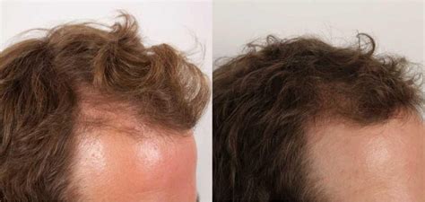 Nutrafol-before-and-after-images- | Reactive Hair