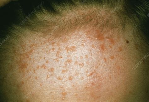 plane warts  scot street blog