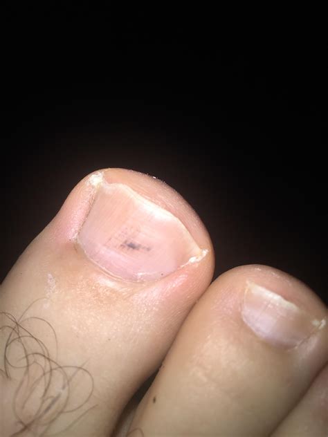 Black under toenail - should I be worried? : r/Melanoma