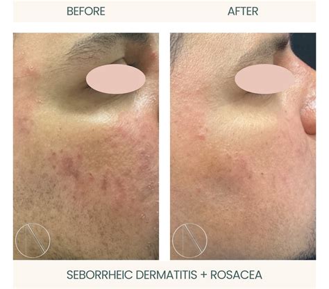 Lupus Rash vs Rosacea: Key Differences and Diagnosis Tips - Ayana