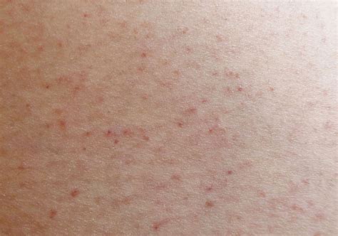 pimples   butt   treatments