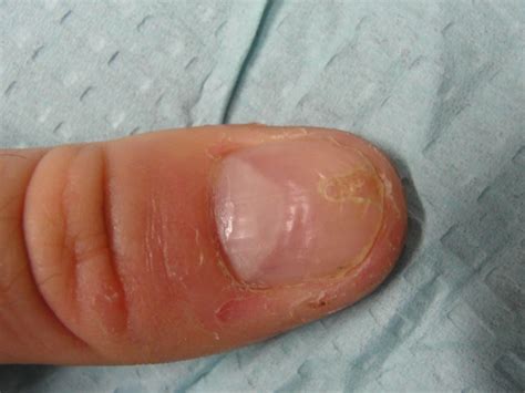 Habit Tic Deformity — Dr. Dana Stern | Dermatologist | Nail Specialist