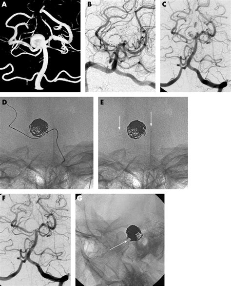 Coiling of basilar tip aneurysms: Results in 154 consecutive patients ...