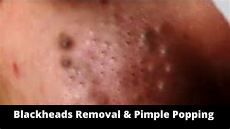 Unbelievable Blackhead Removal 2024: The #1 Trend You Need To Know About - l7llmtl