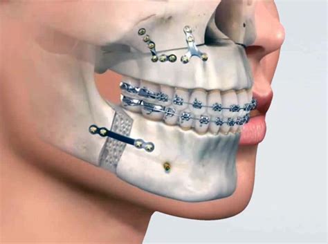 jaw surgery  overbite procedure recovery   needed