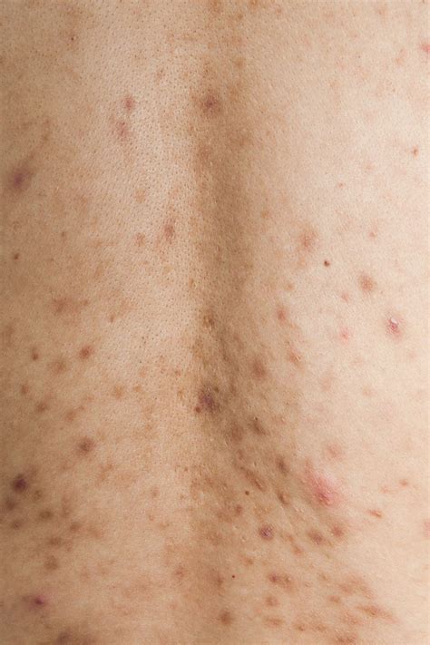 Treating PIH Naturally VS. Chemical Peels – everbella