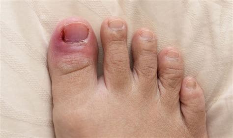 Diabetes: Yeast infection on your toe nails could be warning of high ...