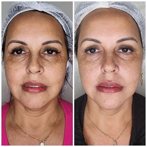Lavieen Antes E Depois Olheiras - BB Laser LAVIEEN: Sua pele naturalmente linda! - Rãmaga Pro-Estética