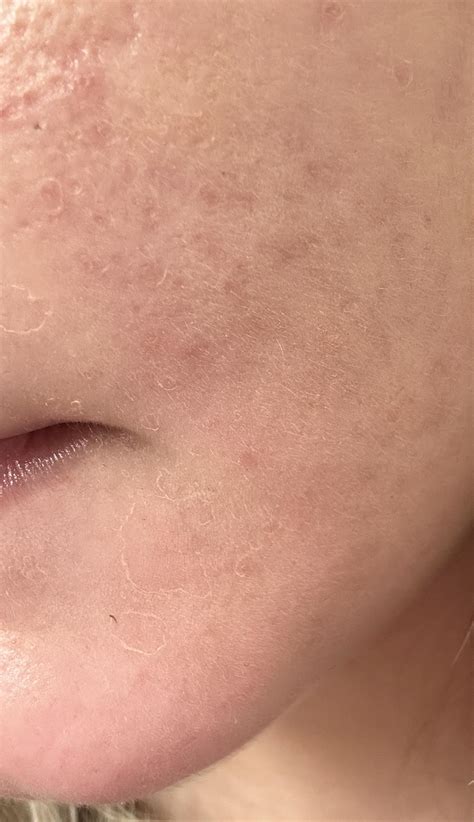 [Routine help] help with peely skin : r/SkincareAddiction