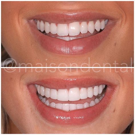 composite teeth bonding near me - Chia Hauser