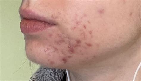 Acne scars from PCOS making me feel depressed : r/AcneScars