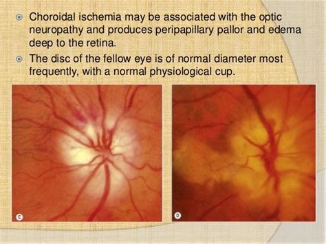 Anterior ischemic optic neuropathy