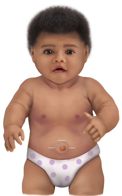 Umbilical hernia repair (child) | healthdirect