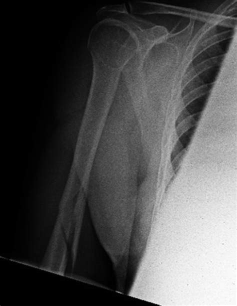 Best Broken Rib X Ray Stock Photos, Pictures & Royalty-Free Images - iStock