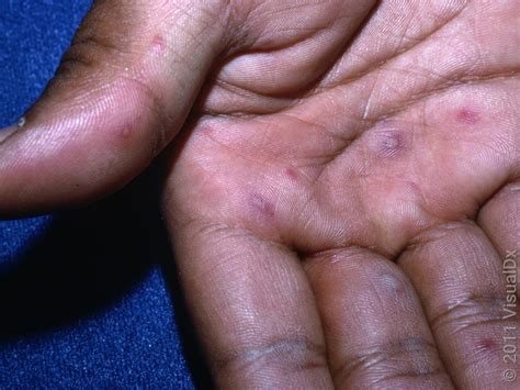 Hand Foot And Mouth Disease In Adults Perth Doctor Warns Of Upsurge In