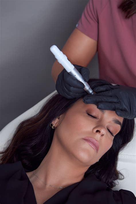Microneedling With PRP — The Refinery