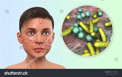 Acne Pimples Closeup View Bacteria Causative Stock Illustration ...