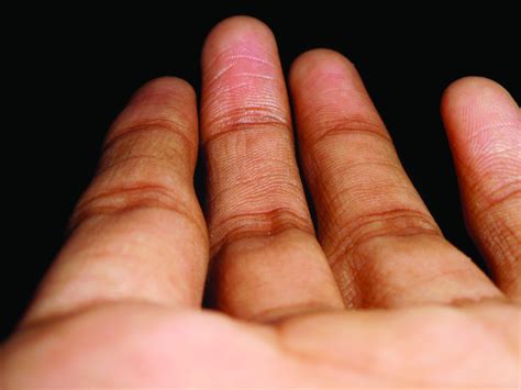 Fingers take the fight to COVID-19 | MDedge Family Medicine