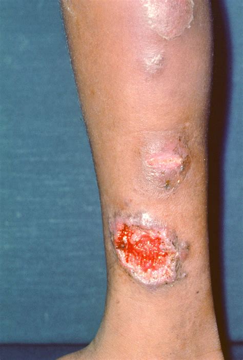 Pyoderma Gangrenosum - Dermatologic Disorders - Merck Manual ...
