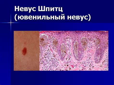 Невусы и меланомы. Морфогенез невусов - презентация онлайн