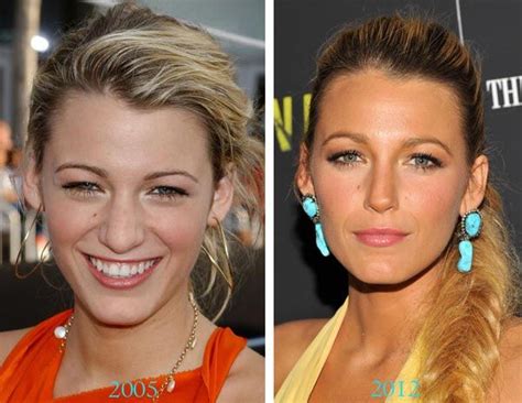 blake chirurgie nez maquillage contouring rhinoplastie