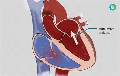 Mitral Valve Prolapse Symptoms Causes Mayo Clinic