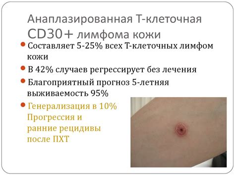 Лимфомы кожи - презентация онлайн